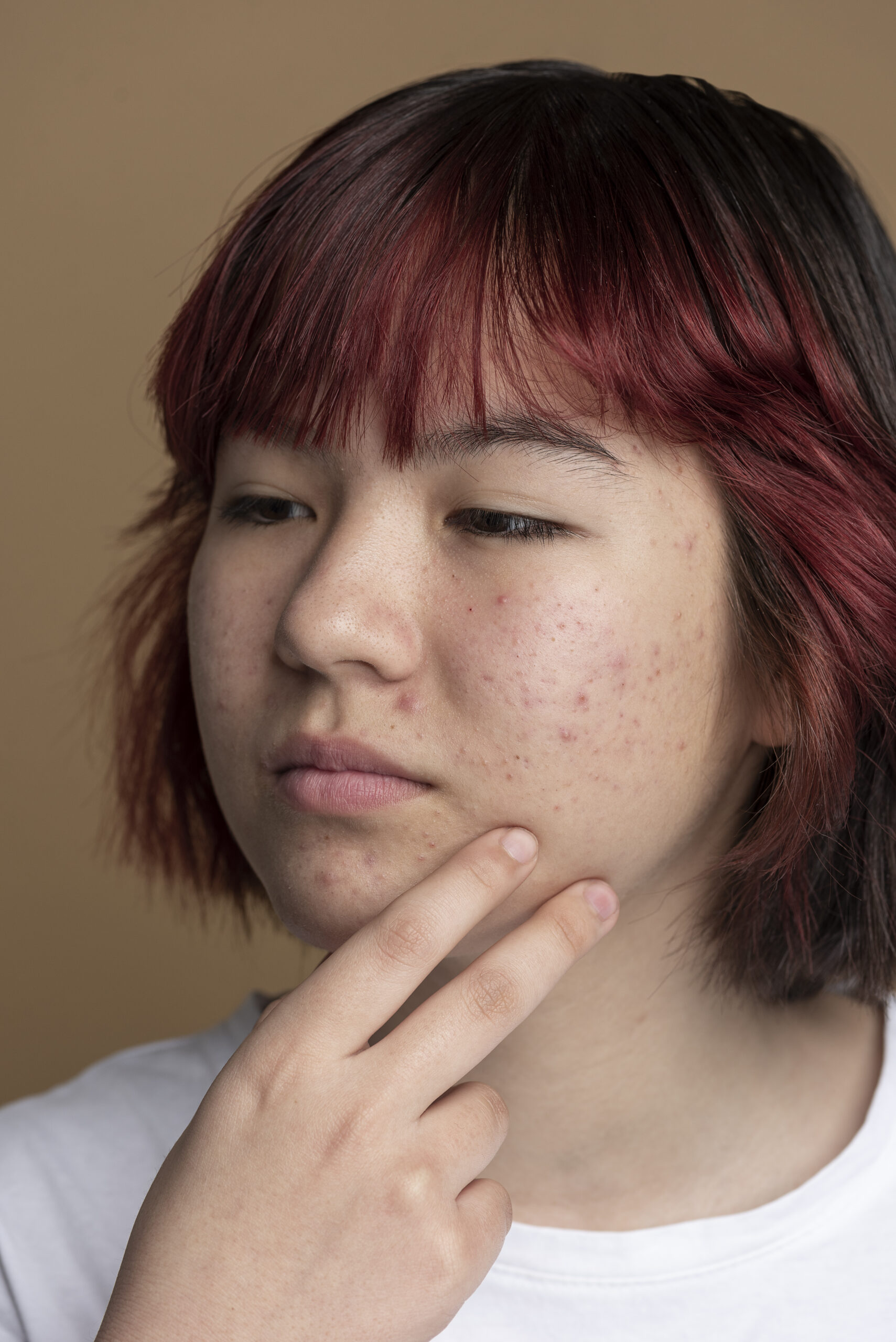 điều trị da mụn